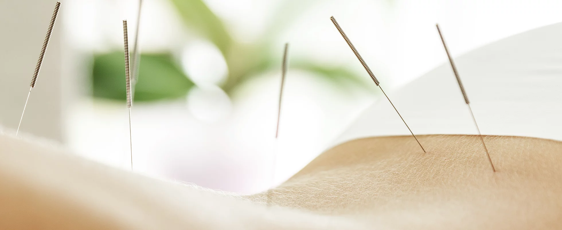 Acupuntura Acupuncture