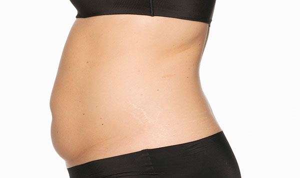 coolsculpting-4-weeks-after-treatment