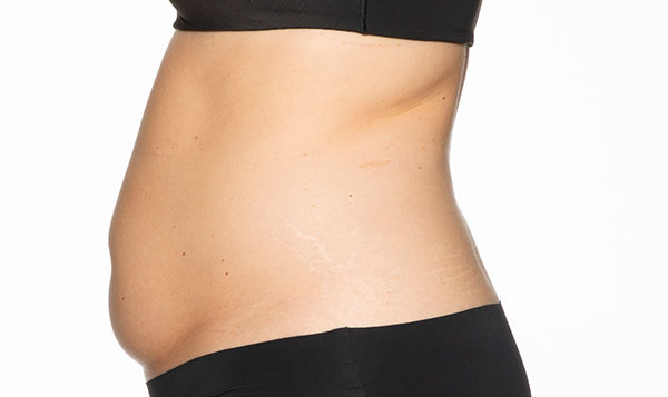 coolsculpting-before-treatment