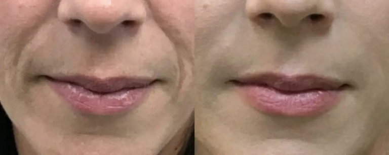 nasolabial-fold-filler-algarve