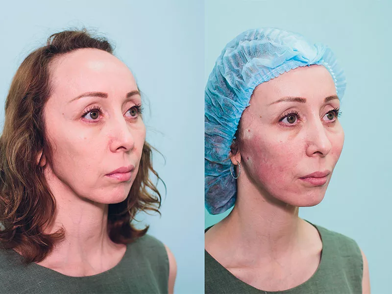 fios-tensores-antes-depois