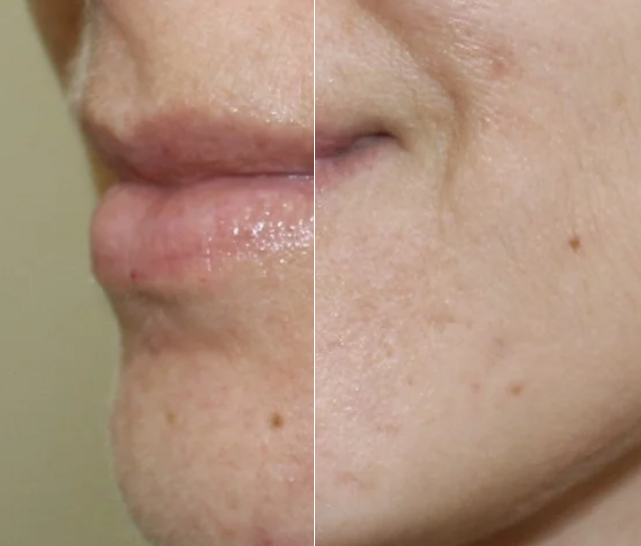 peeling-facial