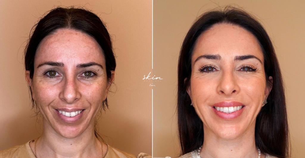transformação-harmonização-facial