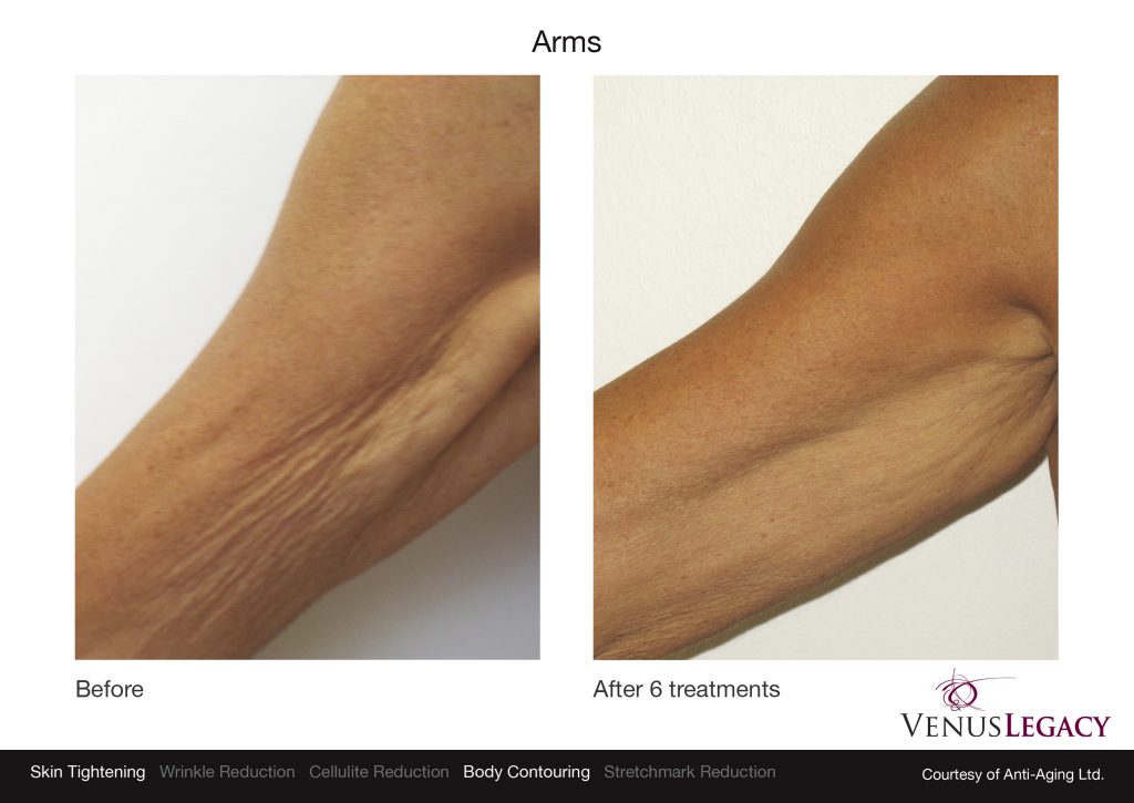 venus-legacy-antes-depois