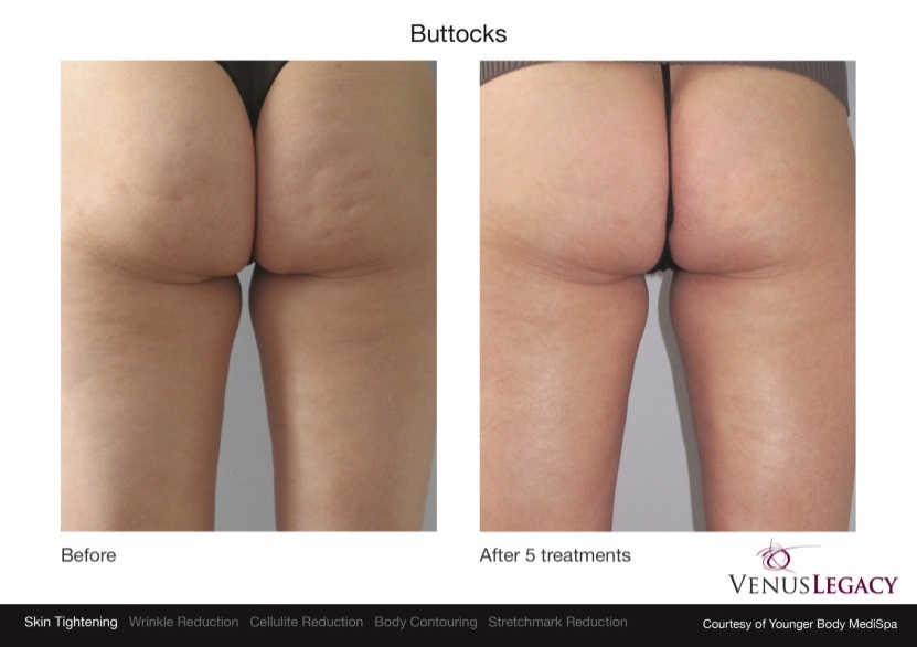 venus-legacy-cellulite