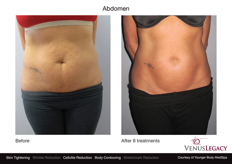 venus-legacy-before-after