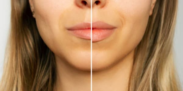 facial-harmonization-lip-fillers