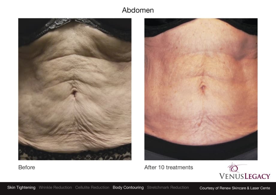 venus-legacy-body-abdomen