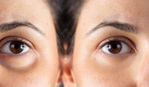 under-eye-filler-before-and-after under-eye-filler