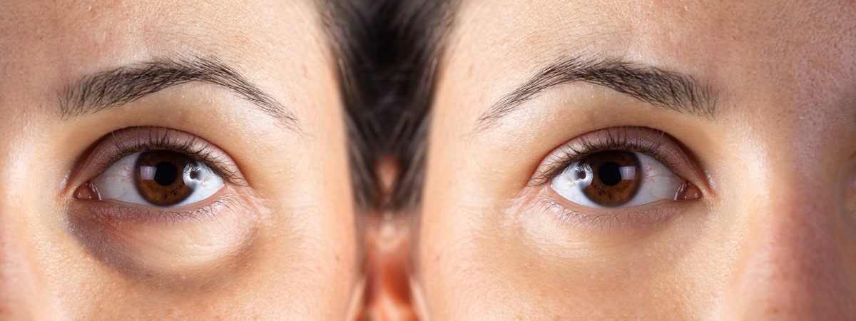under-eye-filler-before-and-after under-eye-filler
